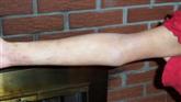 eczema arm after